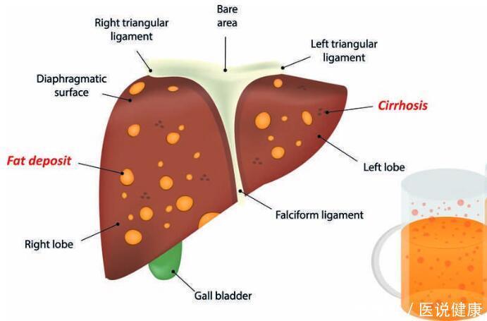 肝癌每年夺走30多万国人性命！医生：不想得肝癌，养肝牢记这4点
