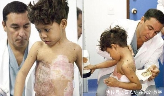 国外一8岁男孩从小身患怪病，每天背着”龟壳“出门
