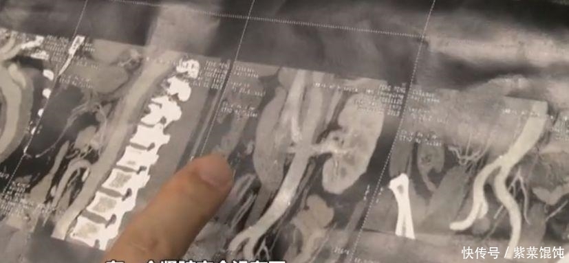 降压药|男子私自停药靠喝茶降血脂 结果痛到瘫痪1个肾没了