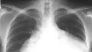 运动|高血压运动能降压！但运动有3怕！1注意！所有高血压人需要知道