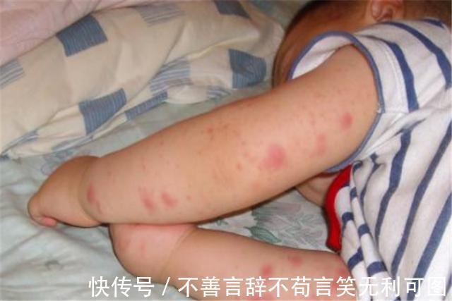 小雨|妈妈擅自为2岁宝宝驱蚊,却致其呼吸停止,及时抢救才脱离危险