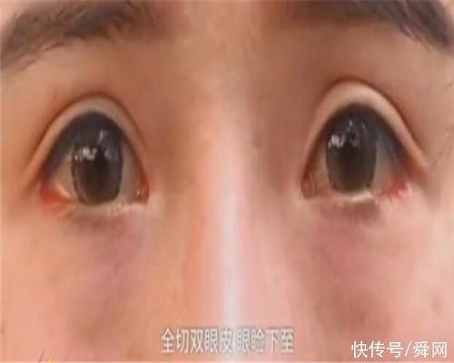 小到 女子整容失败遭破相,术后下眼睑少了一块,就像是腐烂的蚌壳肉……