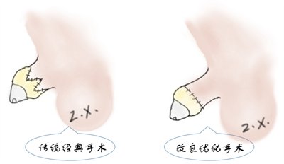 排尿困难|小“丁丁”深藏不露，小问题可能是大隐患