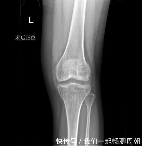 x光片|左边膝盖疼了1年多,结果查出来这一系列问题