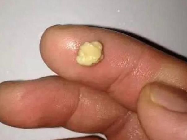 刷牙|女儿嘴太臭被同学孤立,医生从嘴里取出异物,连亲妈都当成作呕