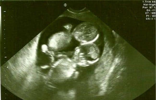 孕检|备孕4年怀上双胞胎,孕检却说是连体婴,妈妈坚持生下后相拥而泣