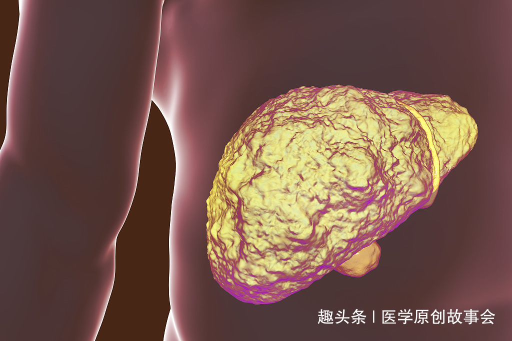 静脉曲张|体内有肝硬化,身体往往有五个标志,占的越多,越要及时治疗