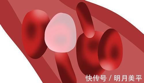 预防动脉硬化|血脂超标的人，医生：2个降血脂的方法，合理降脂，预防动脉硬化