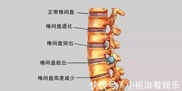 腰椎间盘突出|一个小土方，消除腰间盘突出很简单，一用一个好！