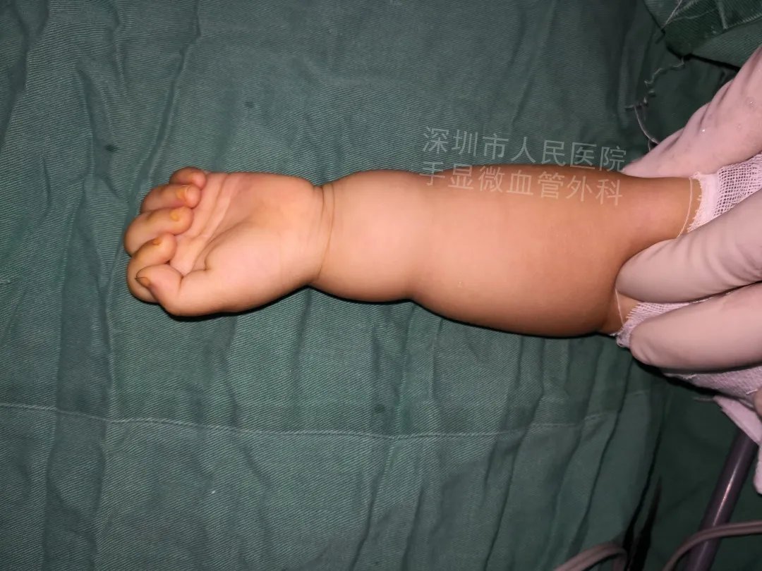 发育不良|得了这病,12岁男孩手指比香蕉还粗!7种常见的手部畸形,家长们要注意