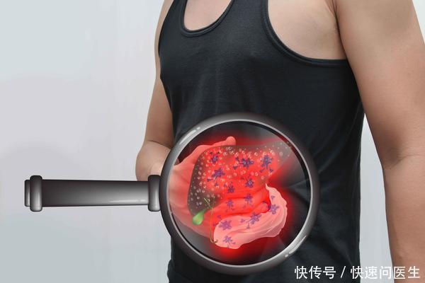  患者|2个症状提醒你同一件事：肝脏受损了，别等到了肝癌才发现