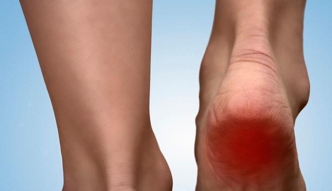 疾病|脚后跟痛是怎么了？医生总结：可能暴露了这2种疾病