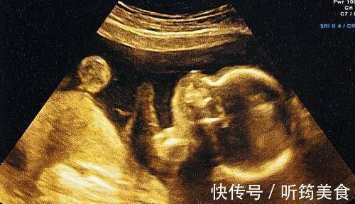 畸形儿|每次产检结果正常,孩子生出后发现畸形,医院需要负责吗?