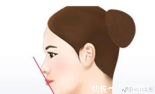 疤痕 做埋线人中缩短,术后嘴巴会不会留疤不自然?