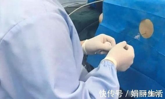 硬膜外麻醉|剖腹产时,麻醉药是如何打进去的?看完麻醉方式,男人该心疼老婆
