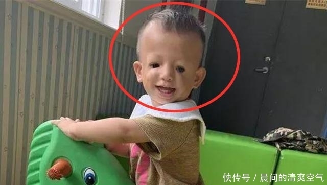 缺陷|女子天生“鸟脸”,却非要生二胎,网友:躲得过初一,躲不了十五