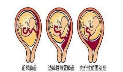 发生|怀孕后胎盘位于前壁，经常散步可以吗会不会很危险