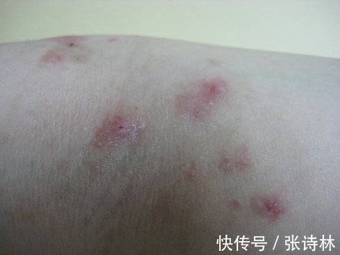 用药|慢性湿疹用什么湿疹膏好 科学用药安全护理