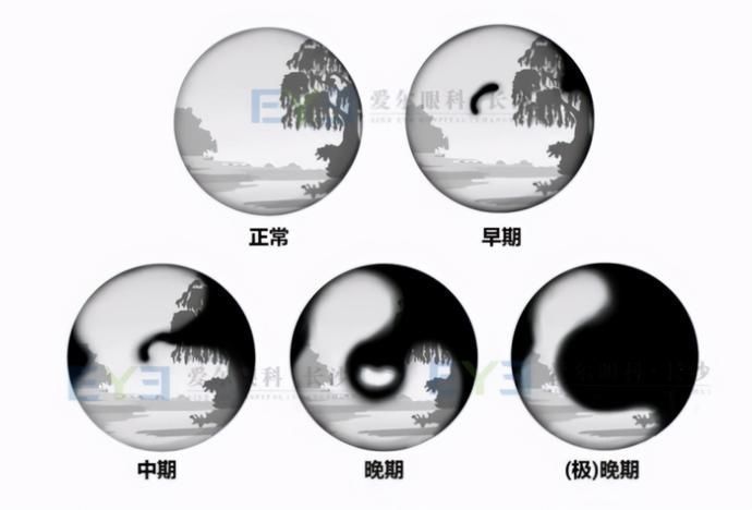 失明|15岁男孩视野受损,眼睛近乎失明!查明原因后让人沉默