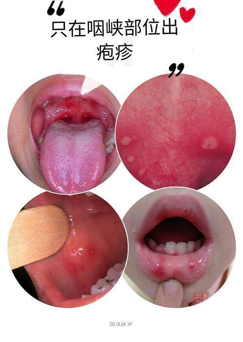 静脉补液|宝宝得了疱疹性咽峡炎该怎么治疗