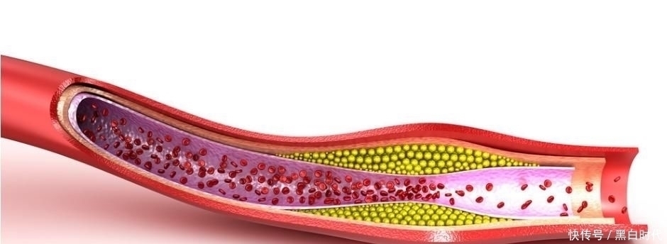 洗净|心血管专家建议开水里加1勺,连喝15天,洗净血管,降低高血脂