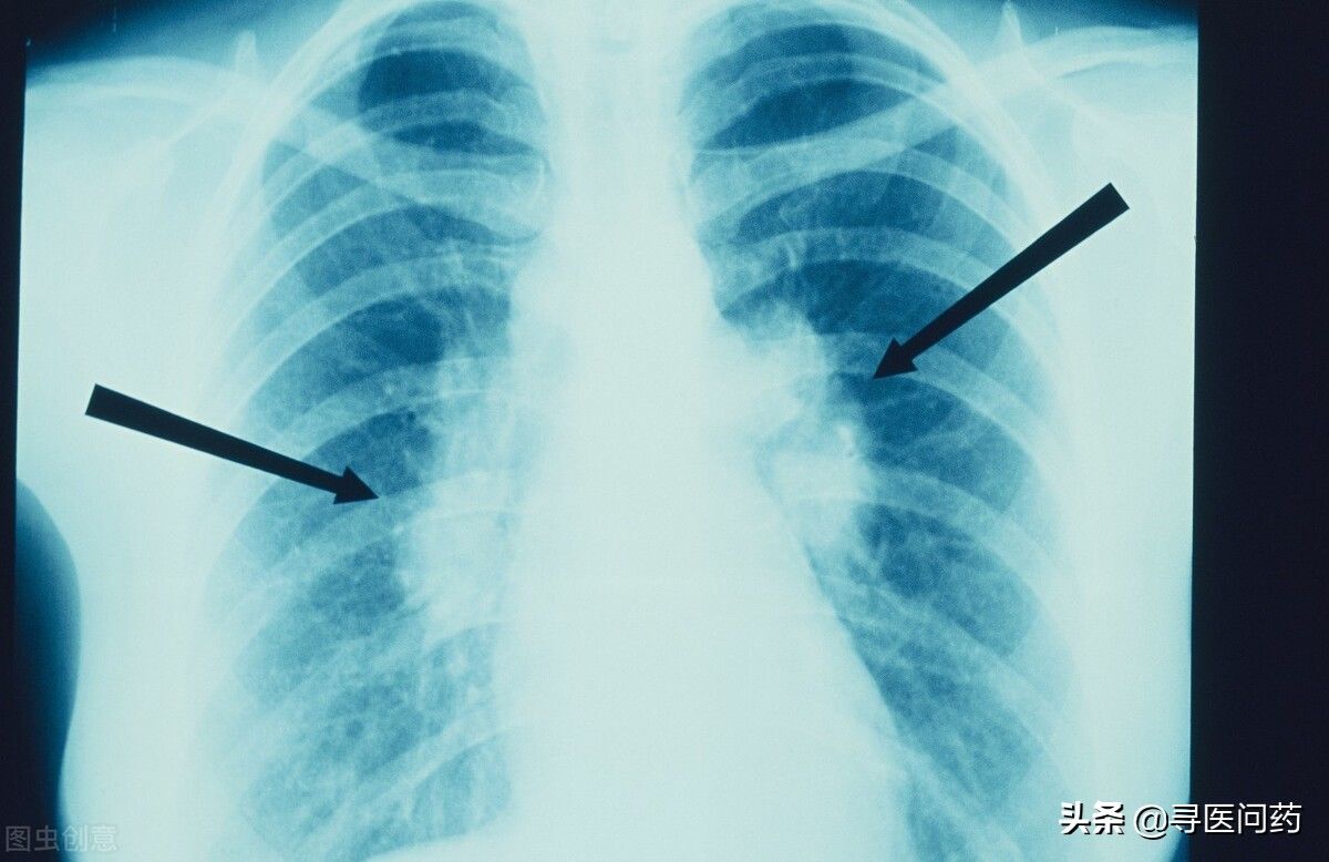 直径|体检查出肺结节,离肺癌还有多远?