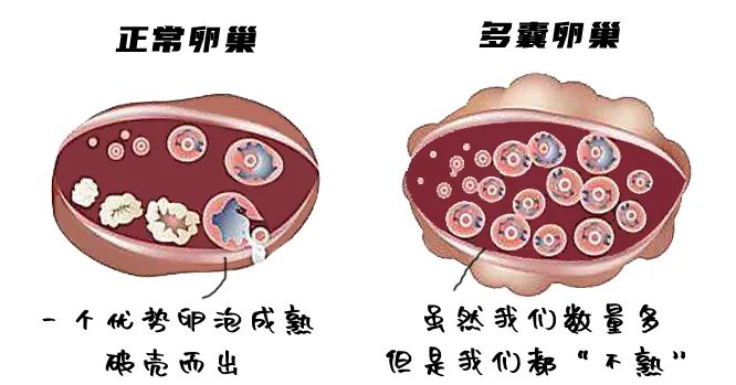 卵泡|长痘、喝水都胖,这个妇科病不仅影响颜值,还影响生娃