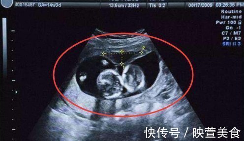 b超检查|孕24周B超检查,当看到宝宝的样子后,孕妈有些吓到了