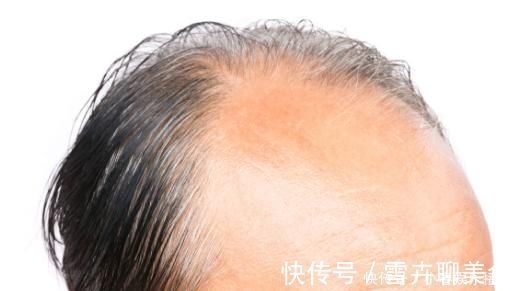 核桃|吃什么能让头发长的快而且茂密?3种食物可以参考一下