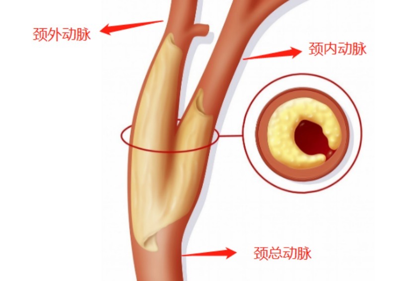 颈动脉|近2亿人有颈动脉斑块，60岁以上几乎全有，2个方法让它“消失”