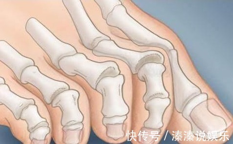 糖尿病足|脚上有4种变化的人，很难躲过糖尿病，占一个，也要注意血糖