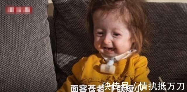 伊利斯|2岁女童看起来像80岁,病情独特全球首例,网友:希望返老还童