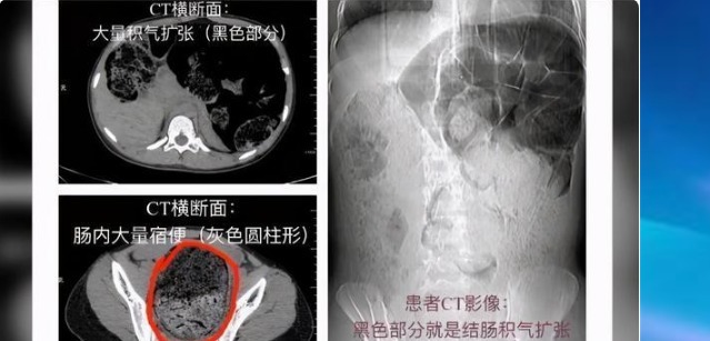  医生|女生肚子疼痛难忍，医生建议灌肠后，陆续排出16斤粪便