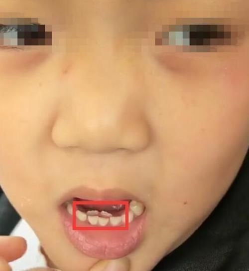 奶奶|7岁男孩长出双排牙，奶奶自责不已，医生：需要一颗颗拔掉