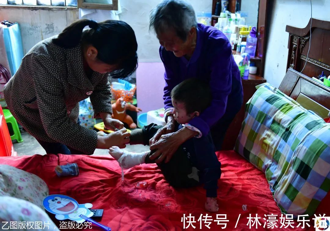 纱布|男童出生患罕见病,三年用掉纱布5000多圈,每天只能坐在床上