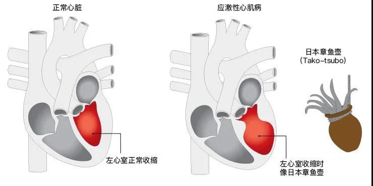 章鱼|【健哥说心脏】心脏里有个章鱼壶——认识应激性心肌病