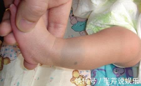 投胎|胎记是投胎时阎王爷打的吗答案可能令你想不到