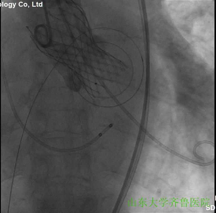 患者|省内首例!齐鲁医院完成一站式经导管主动脉瓣置换术(TAVR)+经皮二尖瓣球囊扩张成形术(PBMV)