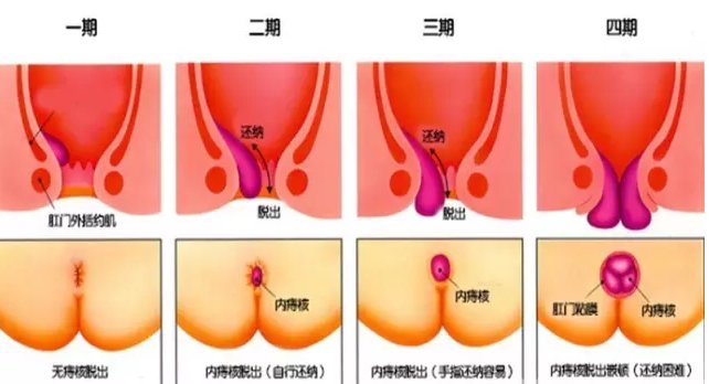 人民卫生出版社|为什么痔疮不要轻易手术？