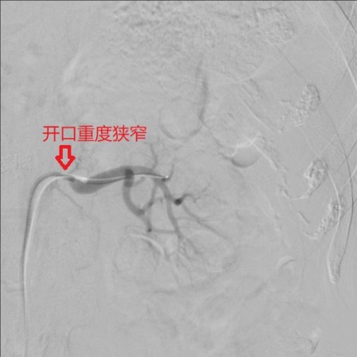 老人5个支架闭塞 4条动脉被堵 市立介入团队挑战医学禁忌成功打通阻塞血管