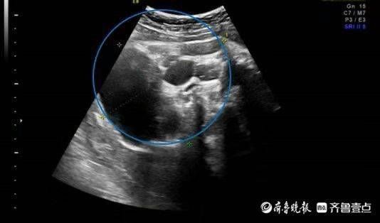 宝宝|宝宝还没出生就长了脑袋大的肿瘤，不用终止妊娠顺利出生并康复