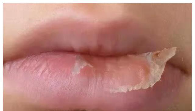 润唇膏|冬季孩子嘴唇起皮、干裂还出血?三招教你正确护理,光喝水没用