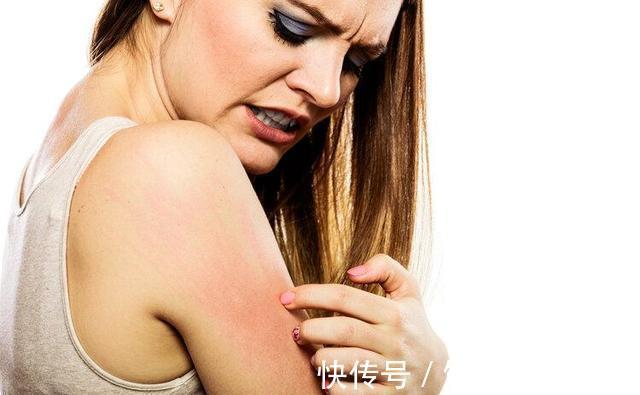 抗菌药物|2块钱一支的红霉素软膏,一般用来治疗什么?这几方面作用突出