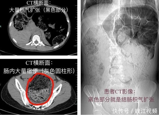  高中生|高中生女孩长期便秘，子宫竟被挤偏！治疗后，她一夜“轻了”8斤