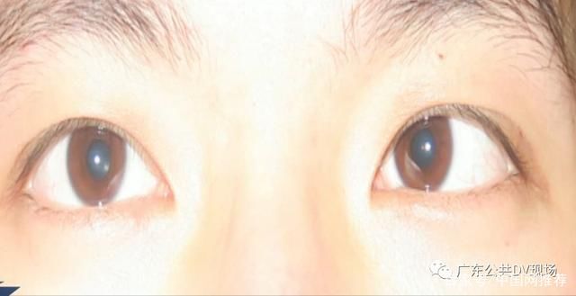 熬夜|警惕!每天熬夜还连玩5小时手机，19岁小伙眼珠“斜了”