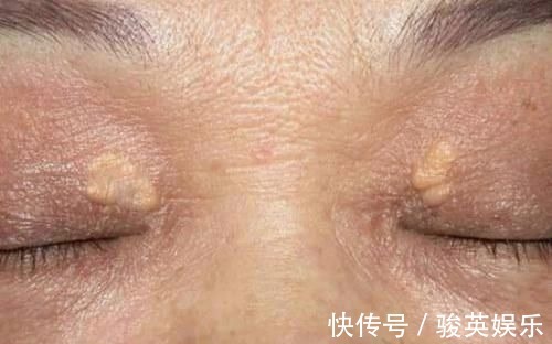 部位|你的眼睑上有小黄瘤子吗?是不是血脂高的象征?营养师说出答案