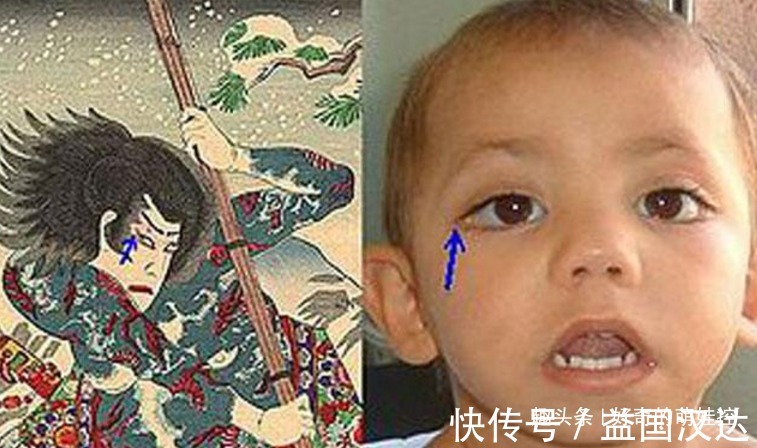歌舞伎面谱综合征|有一种病叫“孩子太漂亮”,天生自带眼妆,是产检查不出的罕见病