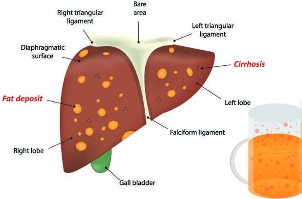 患有脂肪肝 这样做才能够修复受损肝功能