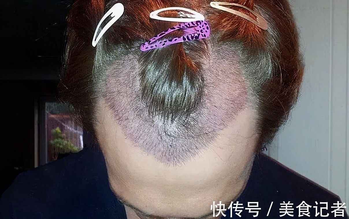 chris 每个月到底有多少人去土耳其植发？