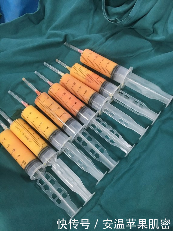 bty油|自体脂肪填充苹果肌,却是瑞典BTY油再修复--详述苹果肌填充过程